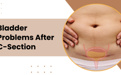 Bladder Problems After C-Section
