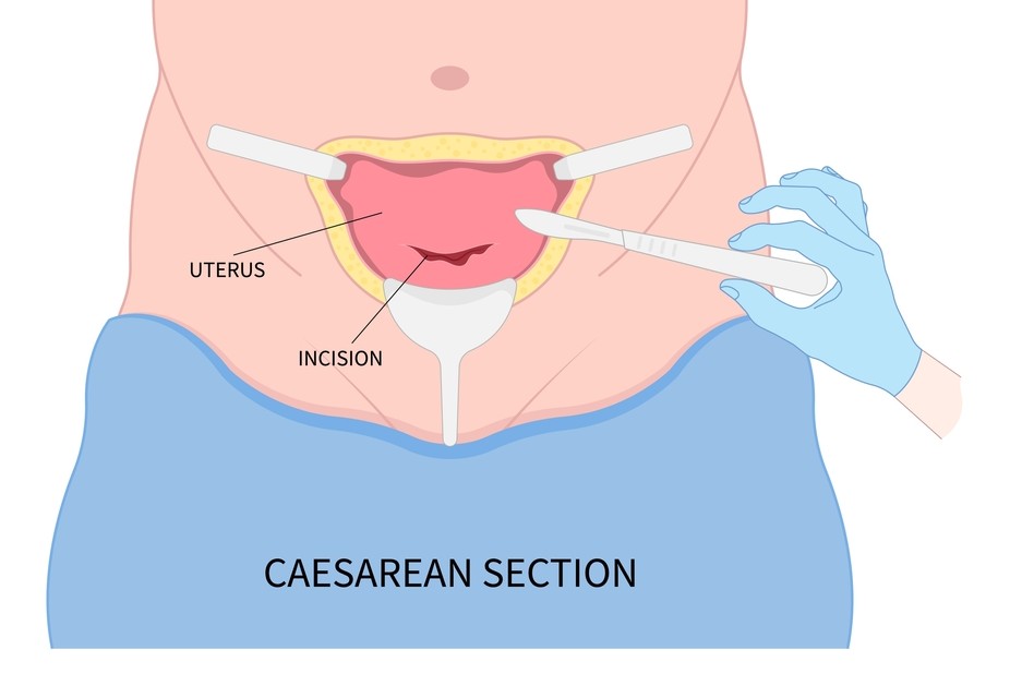 c section - Rahat Hospital after failure of labor