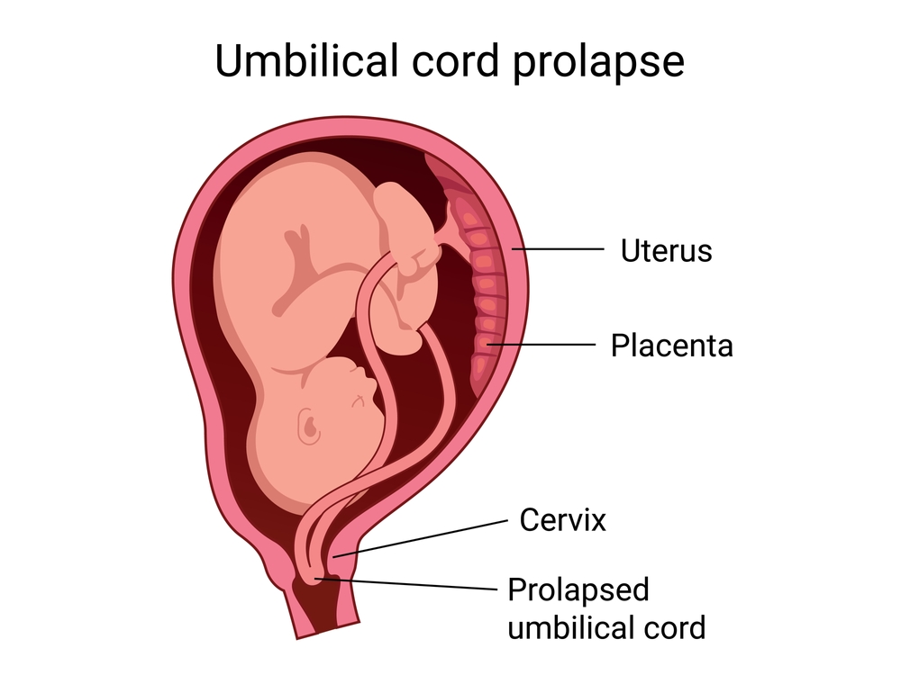Cord prolapse - Rahat Hospital Cord prolapse