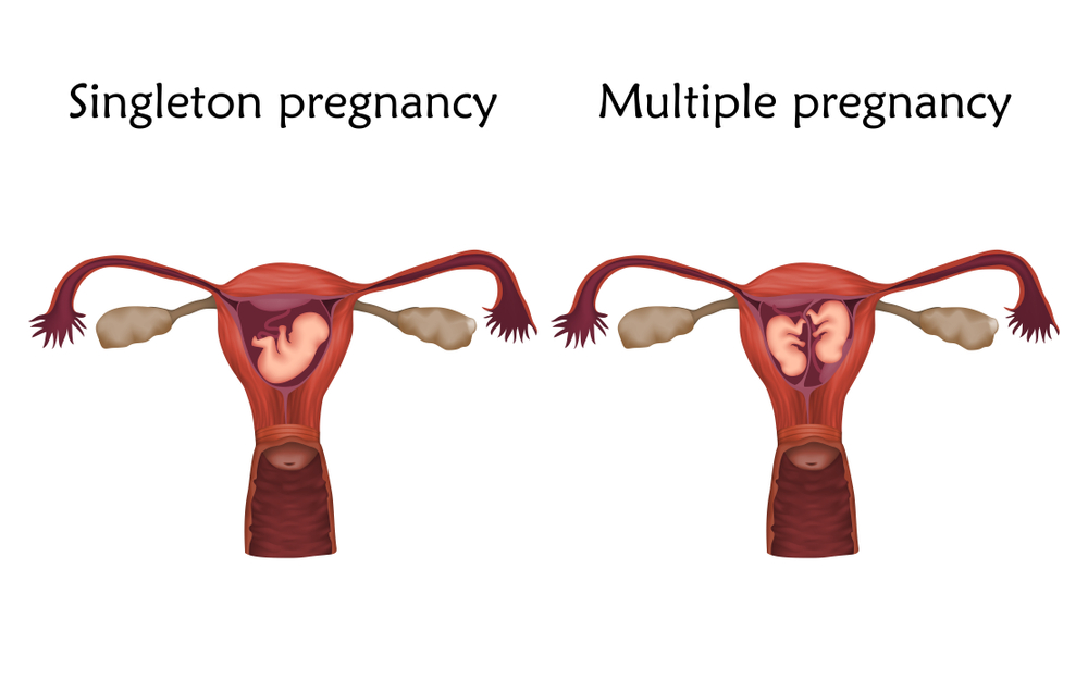 multiple pregnancies - Rahat Hospital multiple pregnancies