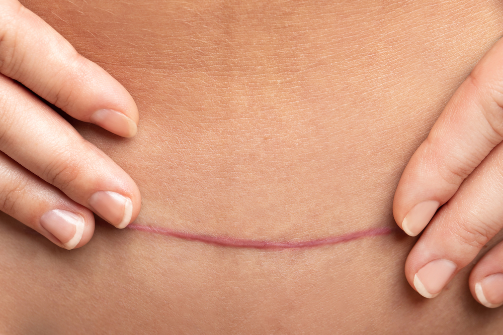 previous uterine surgery - Rahat Hospital previous uterine surgery
